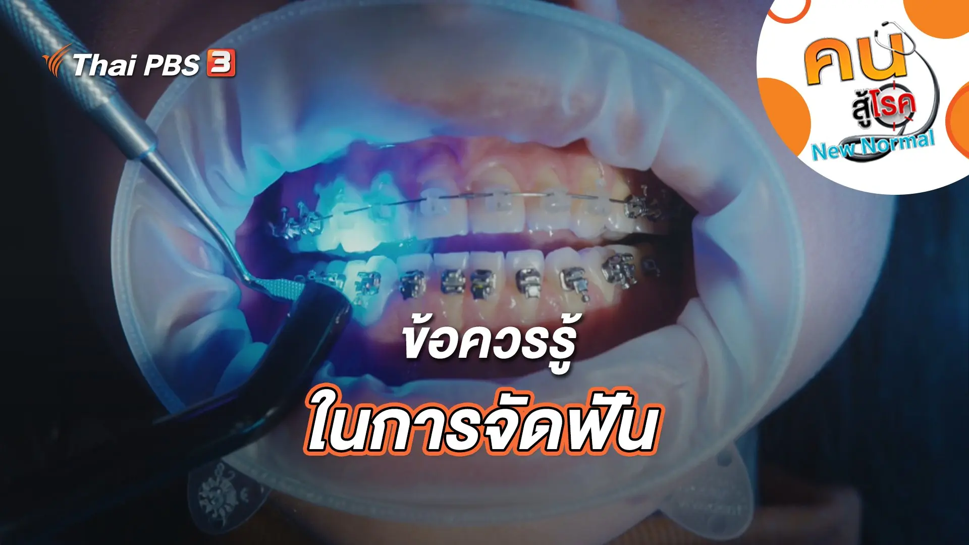 ข้อควรรู้ในการจัดฟัน