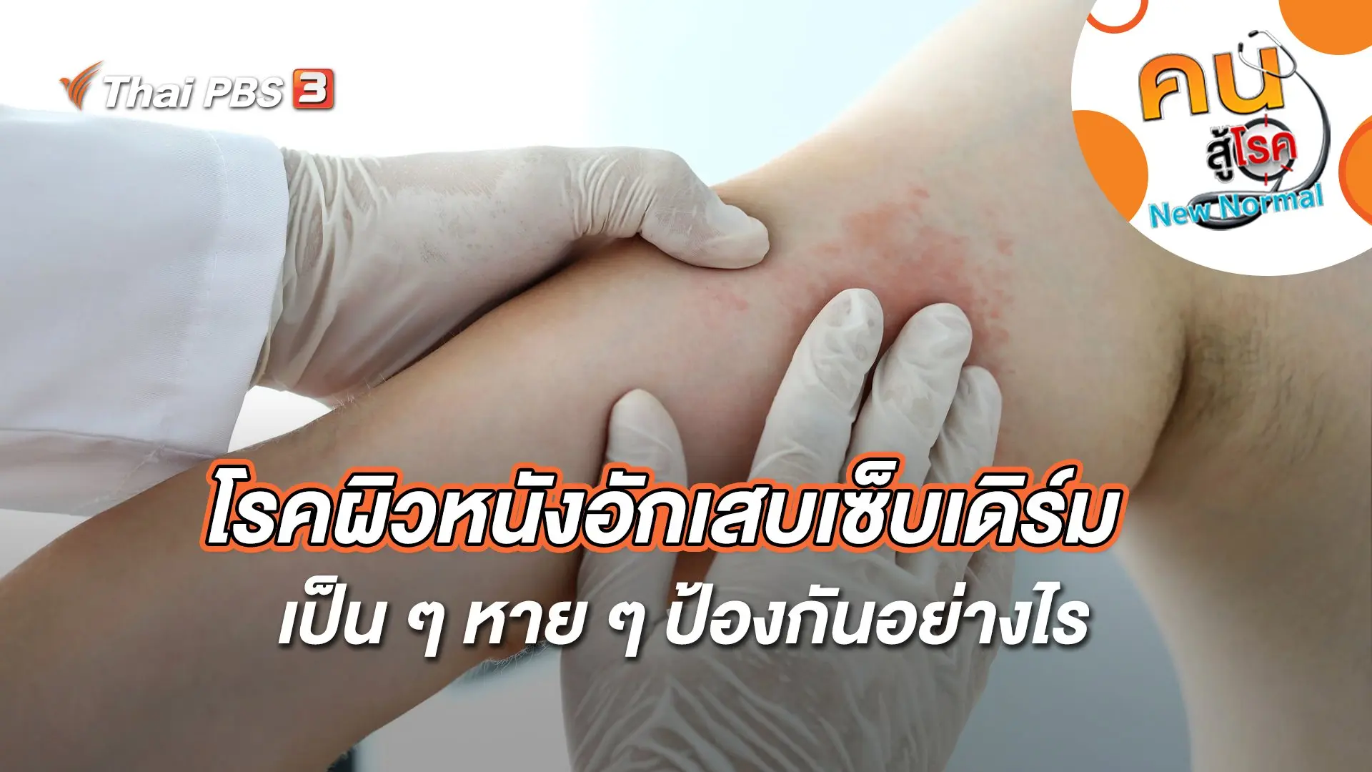 โรคผิวหนังอักเสบเซ็บเดิร์มเป็น ๆ หาย ๆ ป้องกันอย่างไร