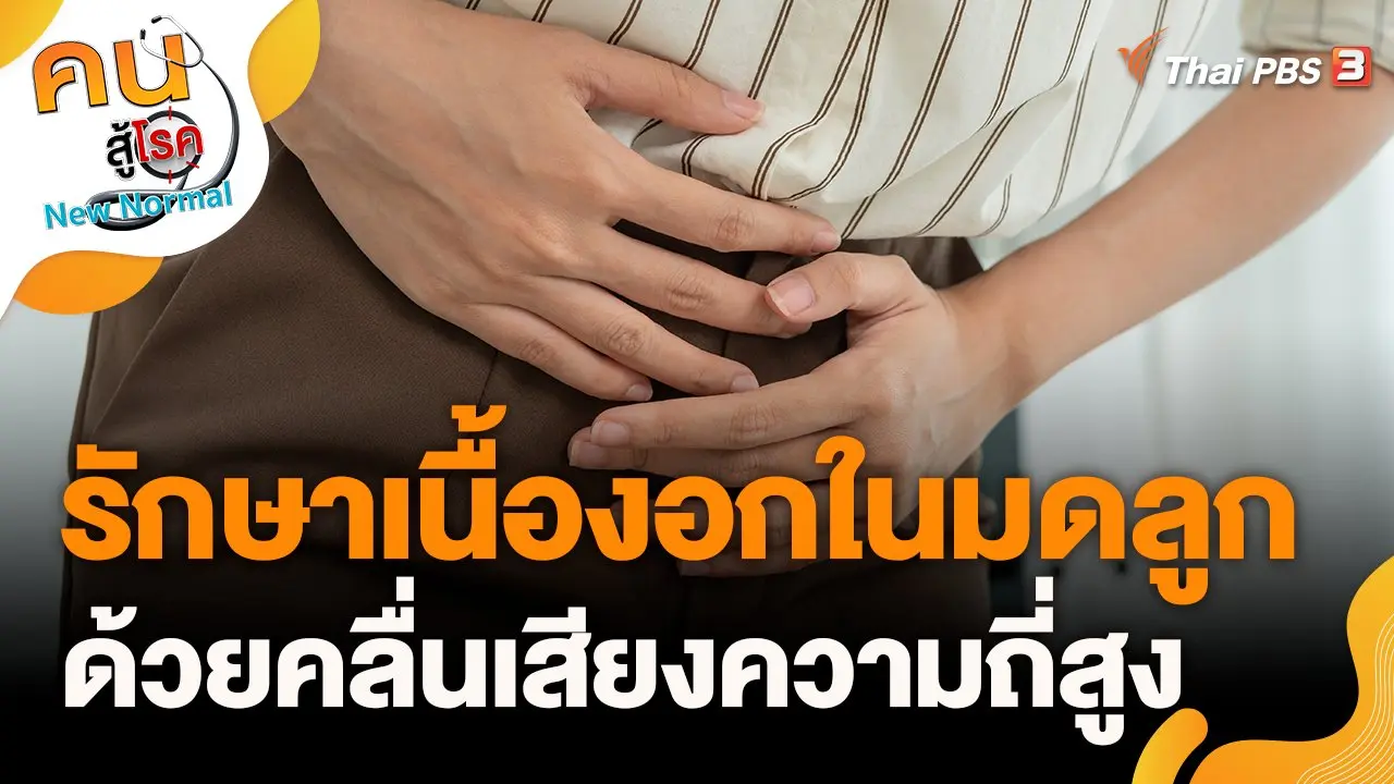 รักษาเนื้องอกในมดลูก ด้วยคลื่นเสียงความถี่สูง