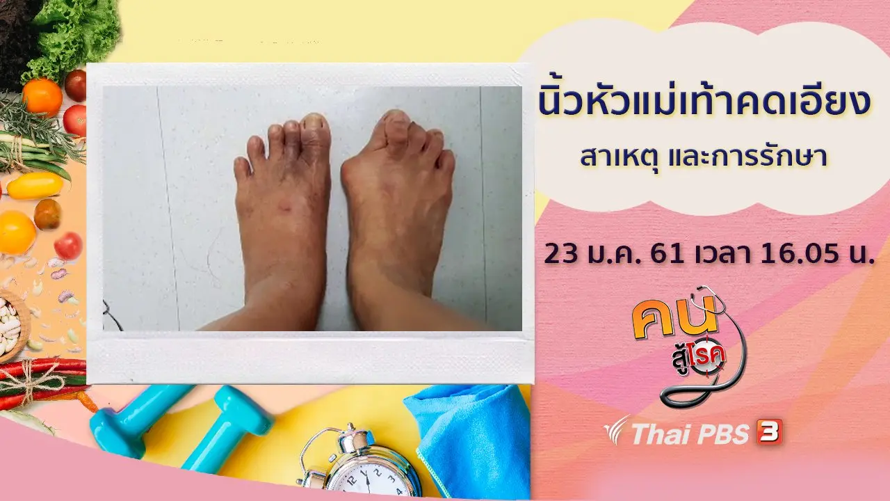 นิ้วหัวแม่เท้าคดเอียง, โยคะแก้อาการปวดหลัง