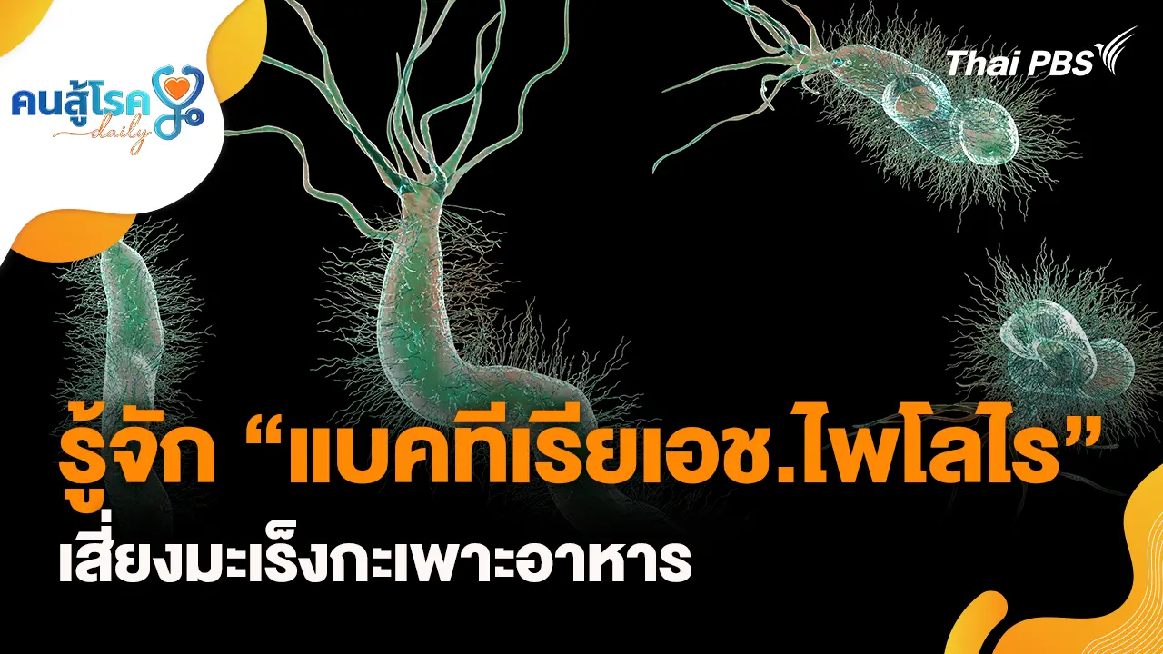 รู้จัก “แบคทีเรียเอช.ไพโลไร” เสี่ยงมะเร็งกะเพาะอาหาร, เลือดกำเดาไหล ให้เงยหน้าขึ้น จริงหรือ ?