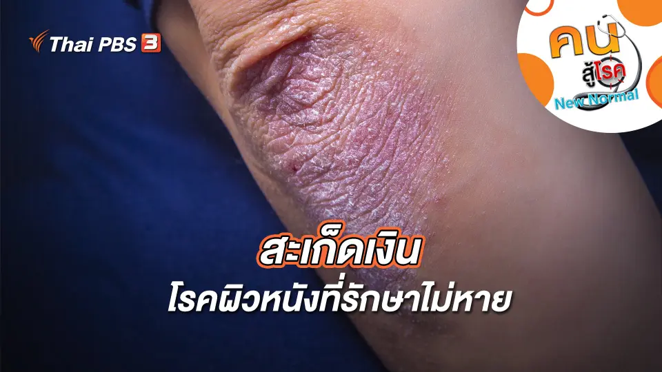 คนสู้โรค