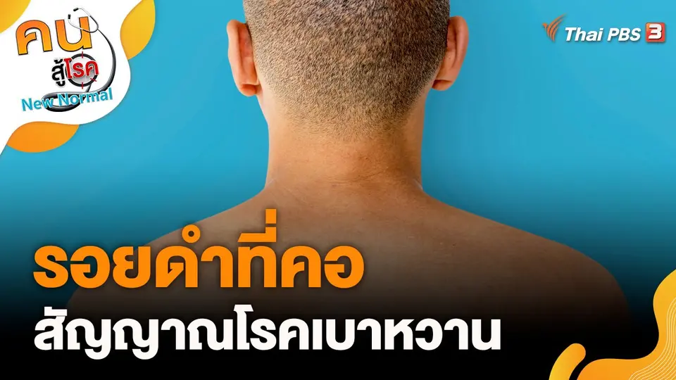 รอยดำที่คอ สัญญาณโรคเบาหวาน