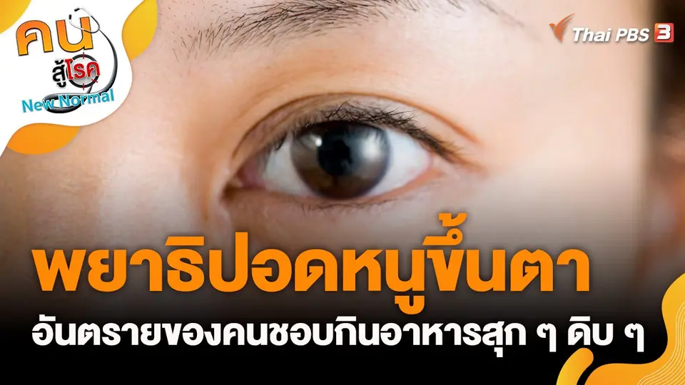 พยาธิปอดหนูขึ้นตา อันตรายของคนชอบกินอาหารสุก ๆ ดิบ ๆ