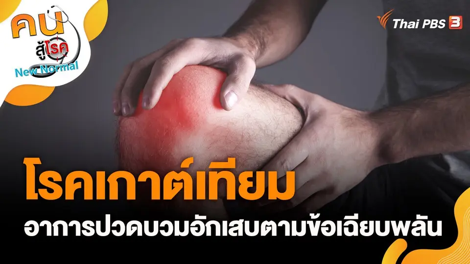 โรคเกาต์เทียม อาการปวดบวมอักเสบตามข้อเฉียบพลัน