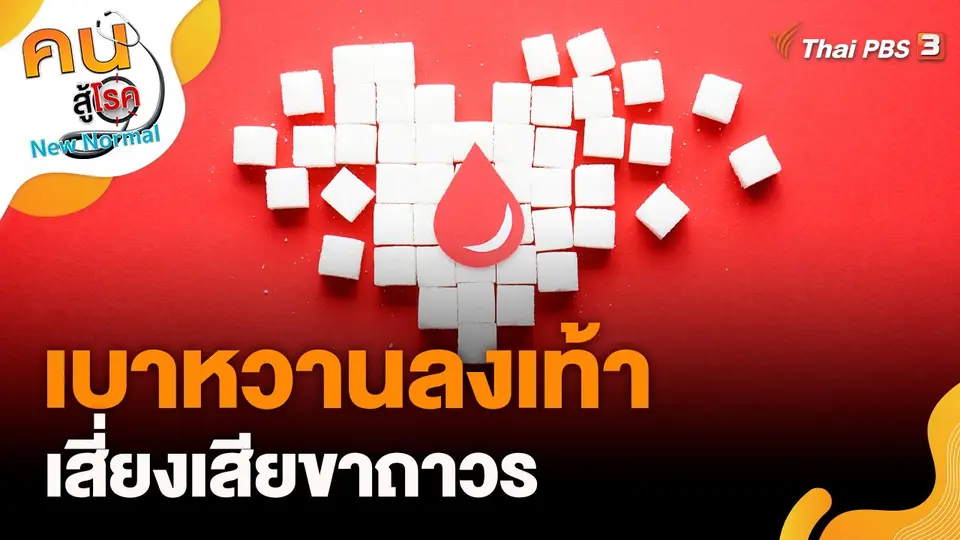 เบาหวานลงเท้าเสี่ยงเสียขาถาวร