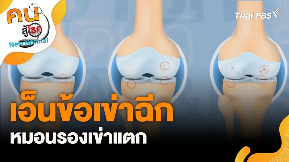 เอ็นข้อเข่าฉีก หมอนรองเข่าแตก