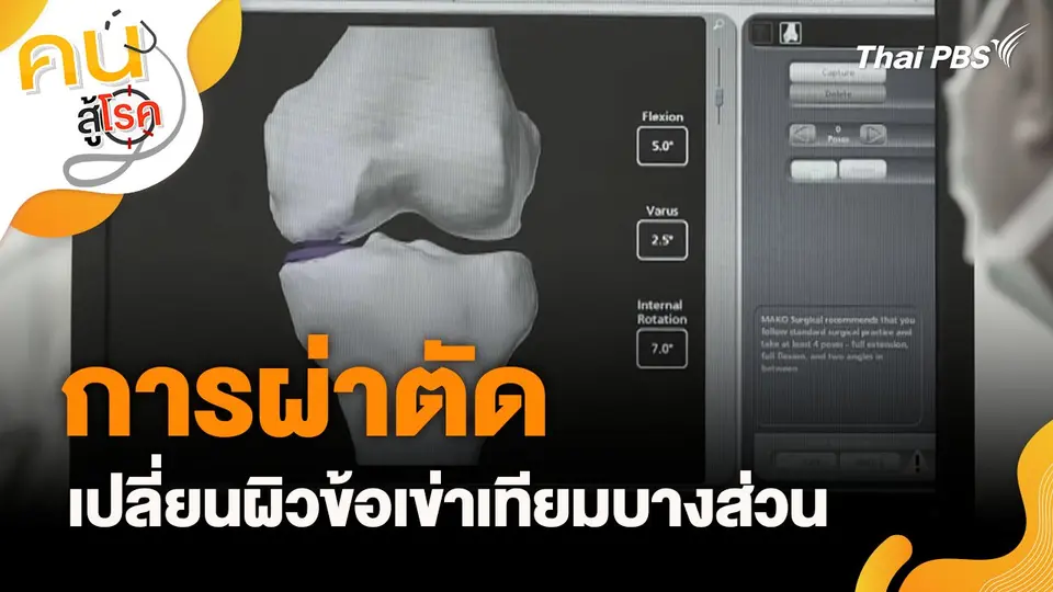 การผ่าตัดเปลี่ยนผิวข้อเข่าเทียมบางส่วน