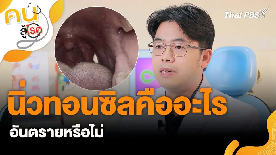 นิ่วทอนซิลคืออะไร อันตรายหรือไม่