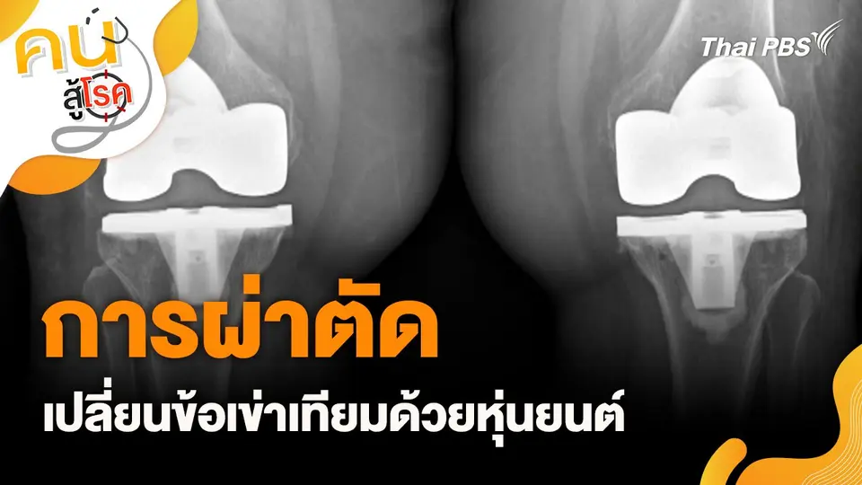 การผ่าตัดเปลี่ยนข้อเข่าเทียมด้วยหุ่นยนต์