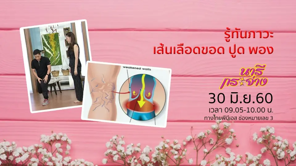รู้ทันภาวะ "เส้นเลือดขอด-ปูด-พอง"