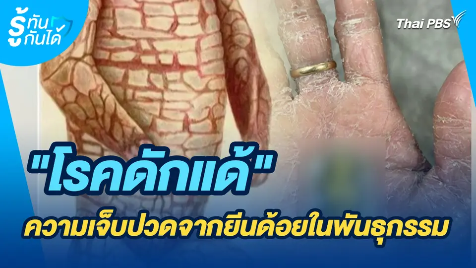 รู้ทันกันได้ : "โรคดักแด้" ความเจ็บปวดจากยีนด้อยในพันธุกรรม