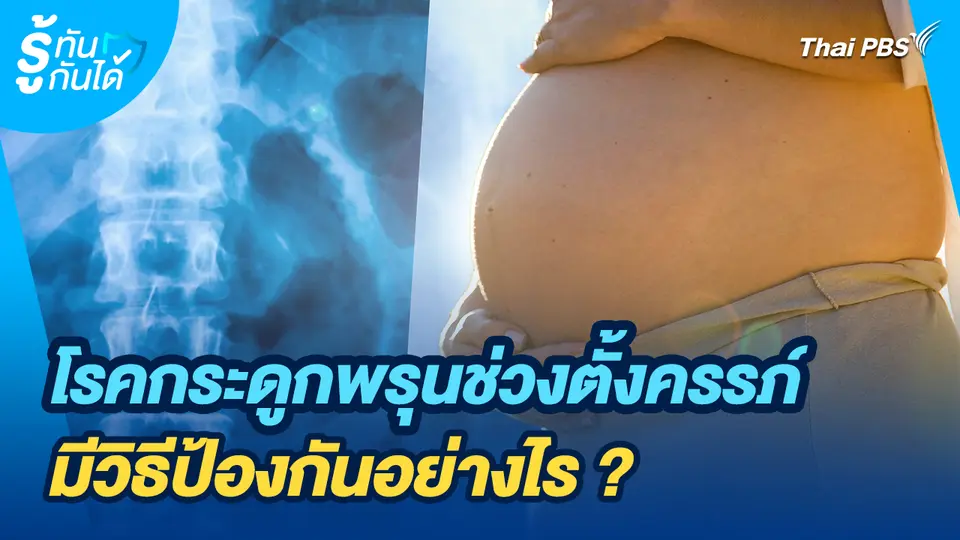 รู้ทันกันได้ : โรคกระดูกพรุนช่วงตั้งครรภ์...มีวิธีป้องกันอย่างไร ?