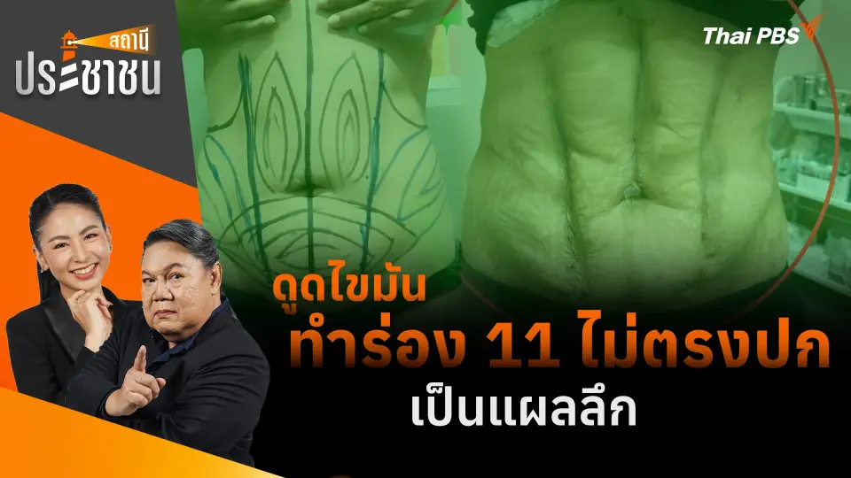 ดูดไขมันทำร่อง 11 ไม่ตรงปก เป็นแผลลึก