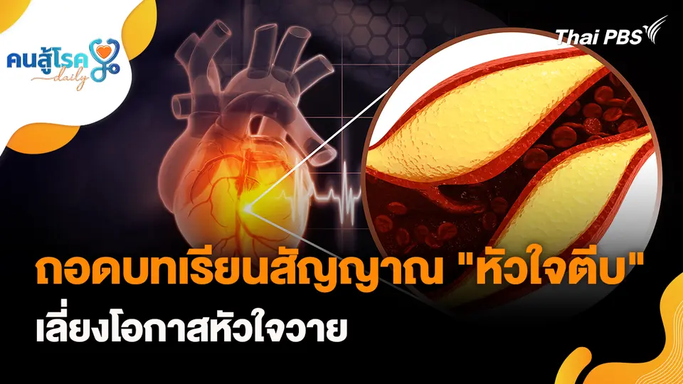 ถอดบทเรียนสัญญาณ "หัวใจตีบ" เลี่ยงโอกาสหัวใจวาย