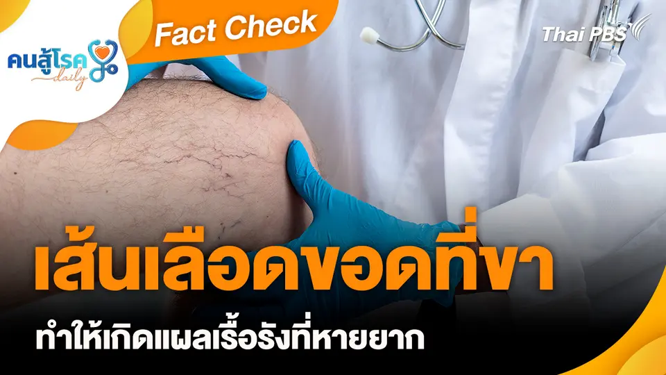 Fact Check : เส้นเลือดขอดที่ขา ทำให้เกิดแผลเรื้อรังที่หายยาก