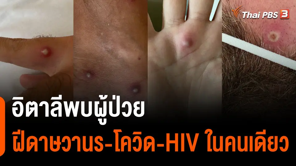 พบผู้ป่วยฝีดาษวานร - โควิด - เอชไอวี ในคนเดียว