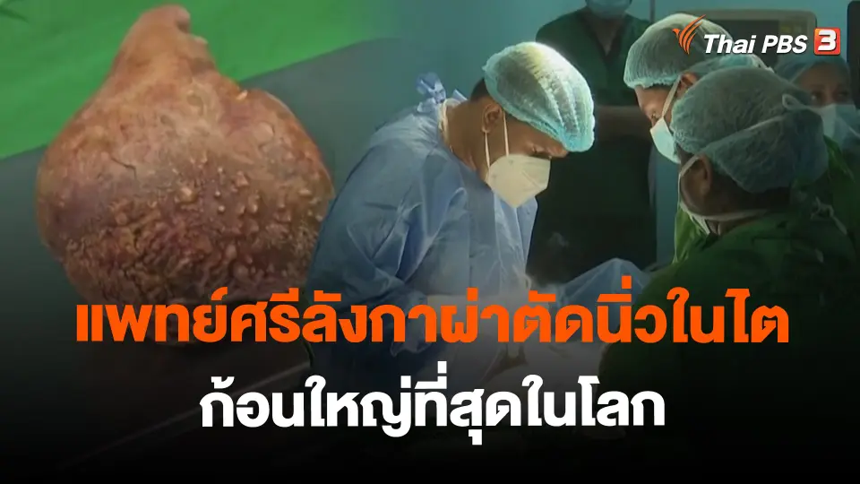 ​แพทย์ศรีลังกาผ่าตัดนิ่วในไตก้อนใหญ่ที่สุดในโลก
