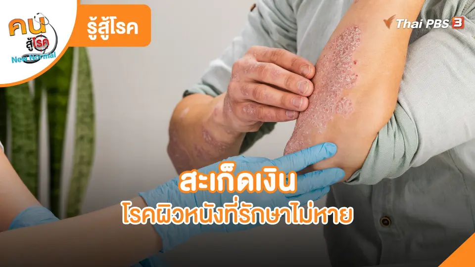 รู้สู้โรค : สะเก็ดเงินโรคผิวหนังที่รักษาไม่หาย