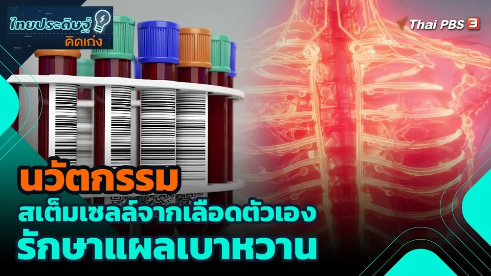 นวัตกรรมสเต็มเซลล์จากเลือดตัวเอง รักษาแผลเบาหวาน