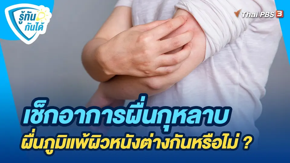 รู้ทันกันได้ : เช็กอาการผื่นกุหลาบ ผื่นภูมิแพ้ผิวหนังต่างกันหรือไม่ ?