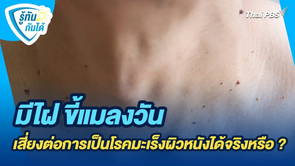 รู้ทันกันได้ : มีไฝ ขี้แมลงวันเสี่ยงต่อการเป็นโรคมะเร็งผิวหนังได้จริงหรือ ?