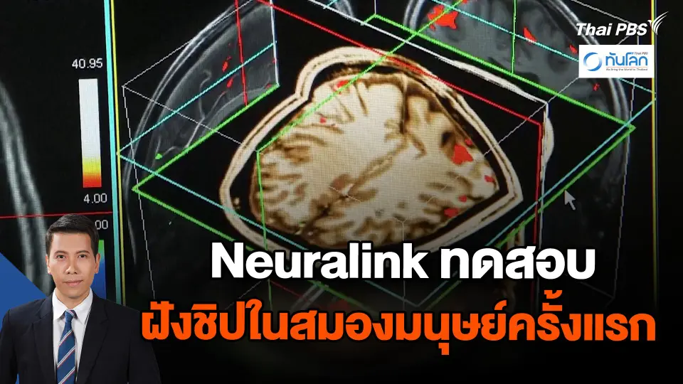 Neuralink ทดสอบฝังชิปในสมองมนุษย์ครั้งแรก