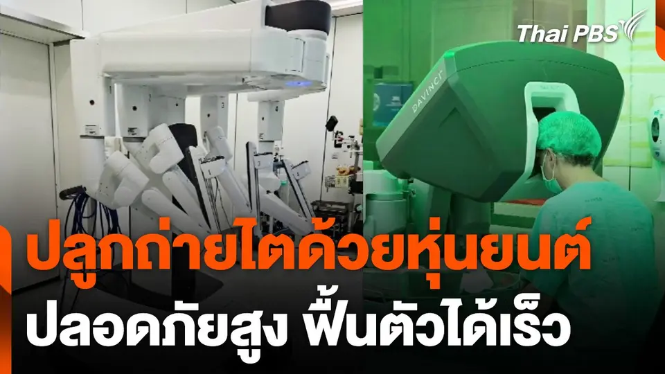 นวัตกรรมปลูกถ่ายไตด้วยหุ่นยนต์ ปลอดภัยสูง ฟื้นตัวเร็ว