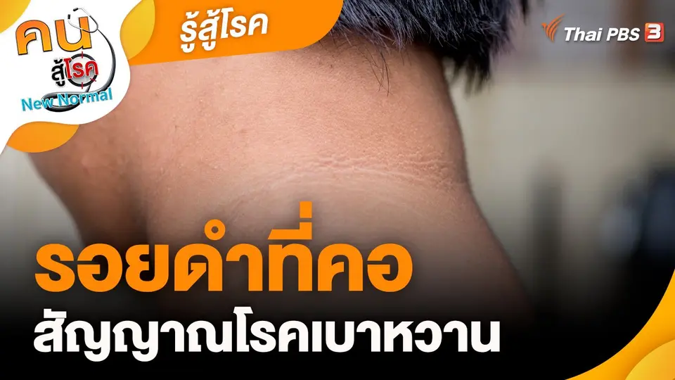 รู้สู้โรค : รอยดำที่คอ สัญญาณโรคเบาหวาน