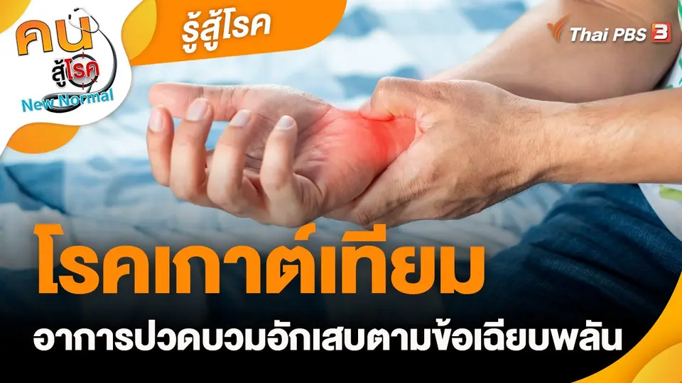 รู้สู้โรค : โรคเกาต์เทียม อาการปวดบวมอักเสบตามข้อเฉียบพลัน
