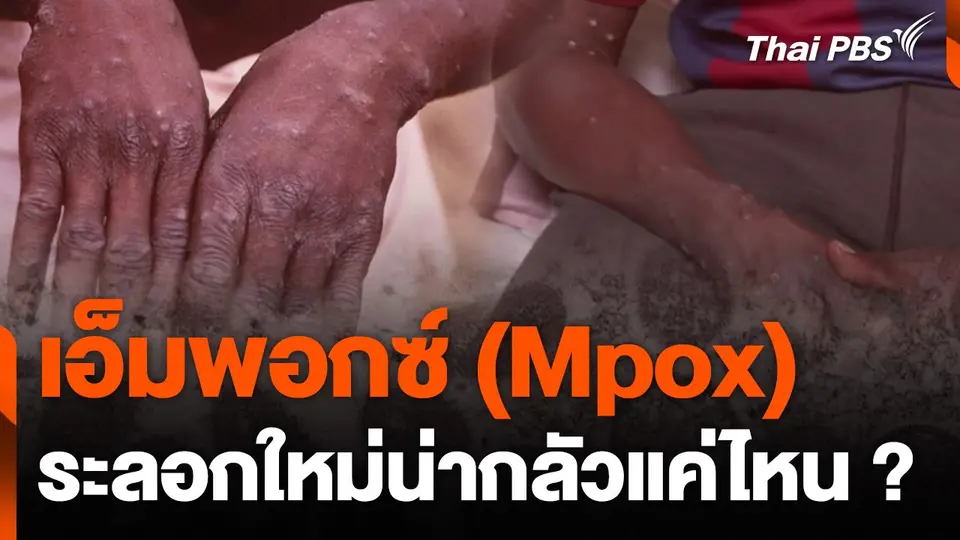 โลกต้องกังวล "เอ็มพอกซ์" (Mpox) หรือ ฝีดาษลิง ระลอกใหม่แค่ไหน ?