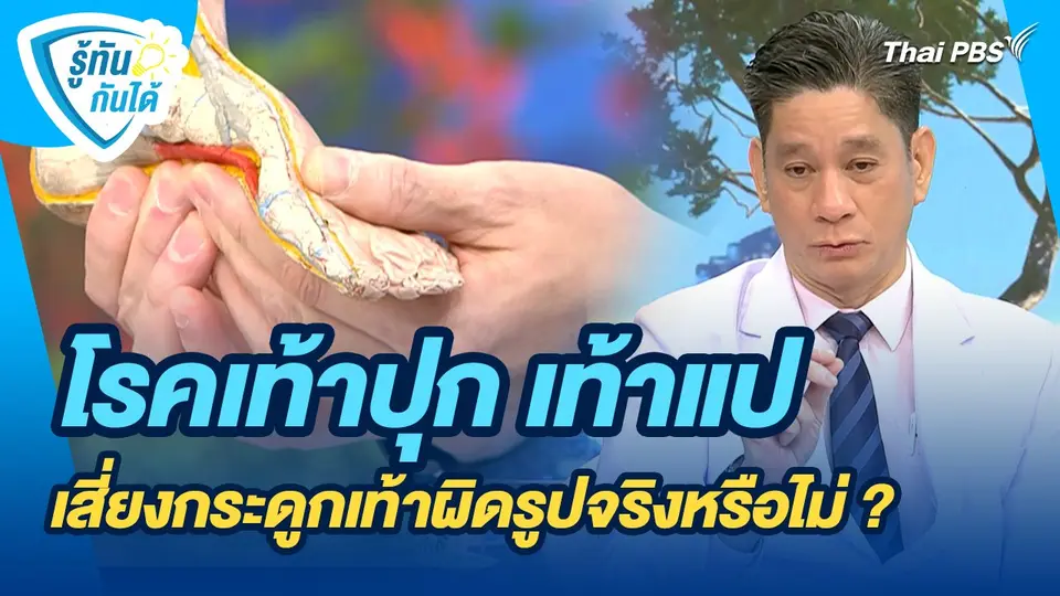 รู้ทันกันได้ : โรคเท้าปุก เท้าแป เสี่ยงกระดูกเท้าผิดรูปจริงหรือไม่ ?