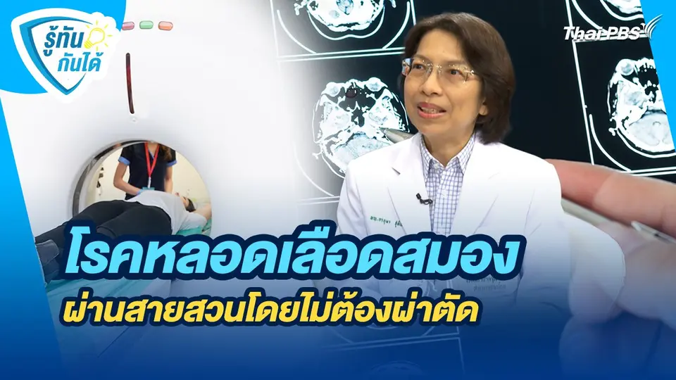 รู้ทันกันได้ : โรคหลอดเลือดสมอง รู้ทันป้องกันอัมพาต