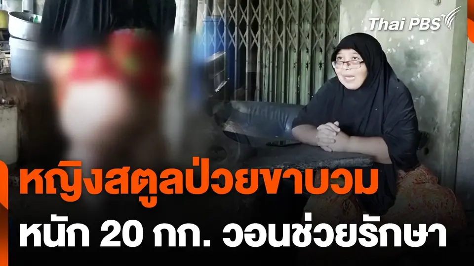 หญิงสตูลป่วยขาบวมหนัก 20 กก. วอนช่วยรักษา