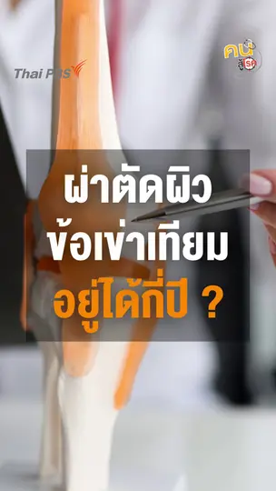 ​ผ่าตัดผิวข้อเข่าเทียมอยู่ได้กี่ปี ?