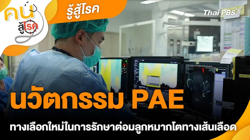 รู้สู้โรค : นวัตกรรม PAE ทางเลือกใหม่ในการรักษาต่อมลูกหมากโตทางเส้นเลือด