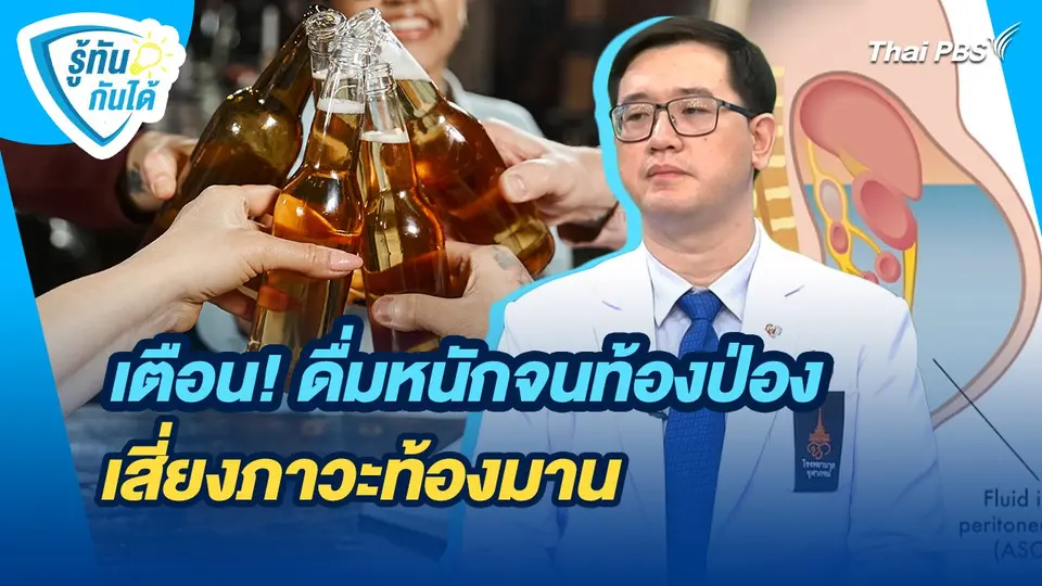 รู้ทันกันได้ : เตือน! ดื่มหนักจนท้องป่อง เสี่ยงภาวะท้องมาน