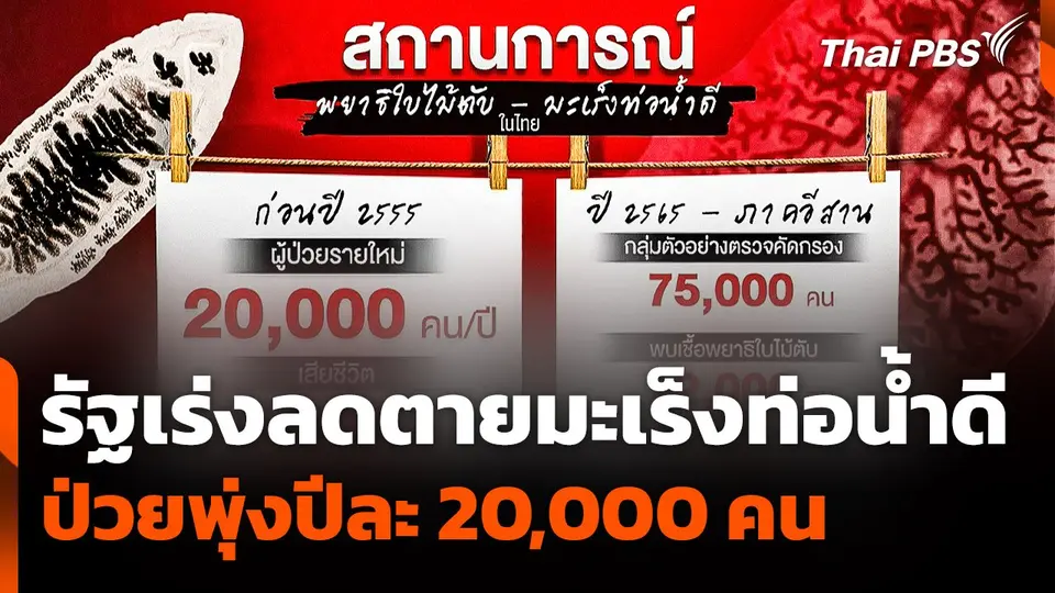 รัฐเร่งลดตาย "มะเร็งท่อน้ำดี" หลังผู้ป่วยพุ่งปีละ 20,000 คน