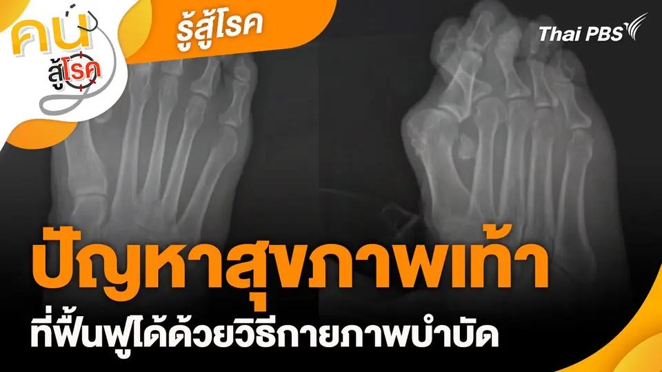รู้สู้โรค : ปัญหาสุขภาพเท้า