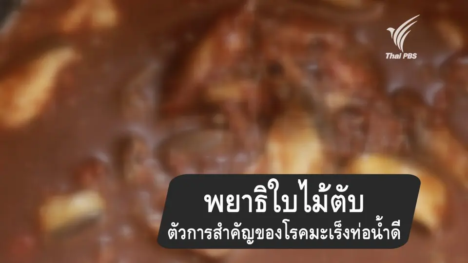 พยาธิใบไม้ในตับตัวการสำคัญของโรคมะเร็งท่อน้ำดี