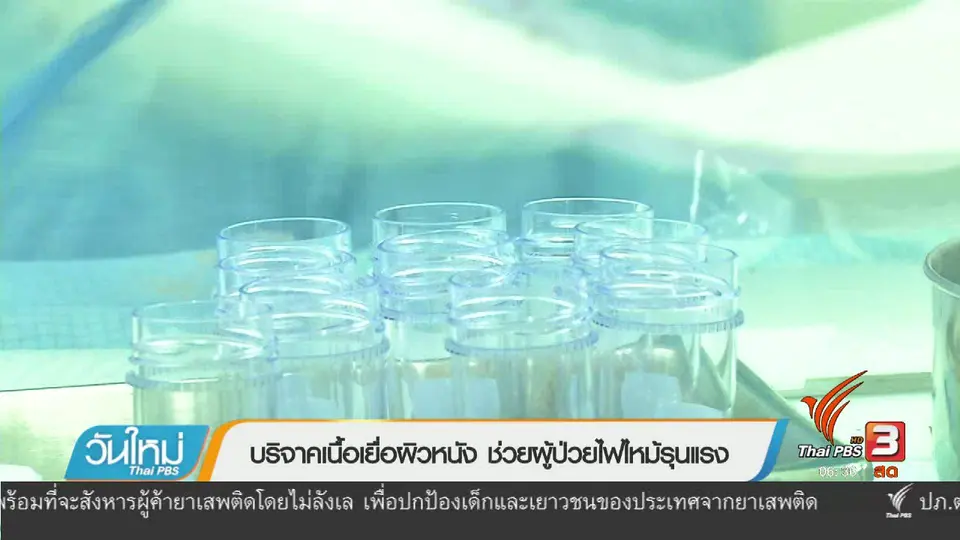 108 สุขภาพ : บริจาคเนื้อเยื่อผิวหนัง ช่วยผู้ป่วยไฟไหม้รุนแรง