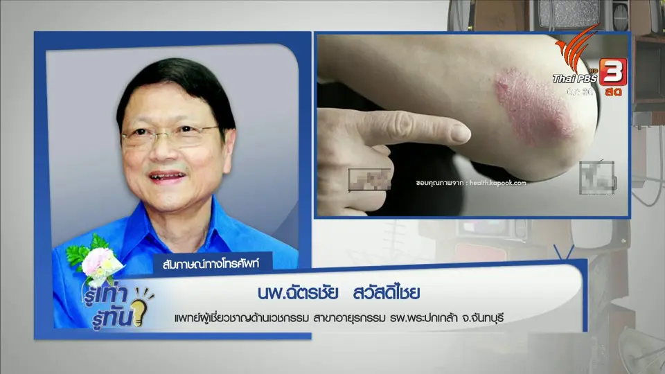 โรคข้ออักเสบสะเก็ดเงิน
