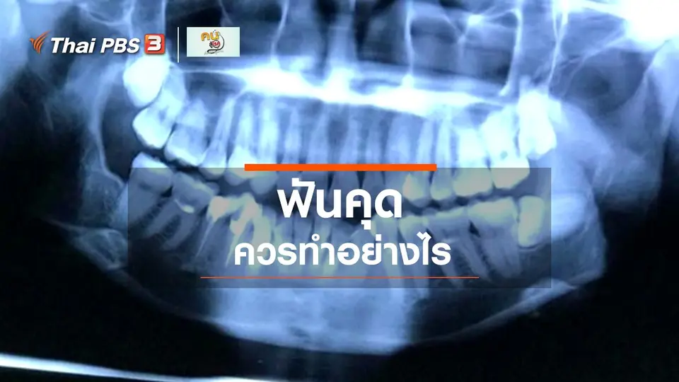 ​รู้สู้โรค : "ฟันคุด" ควรทำอย่างไร