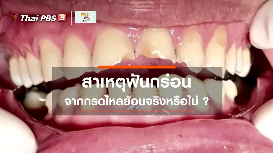 ​รู้สู้โรค : กรดไหลย้อนทำให้ฟันกร่อนได้จริงหรือไม่ ?