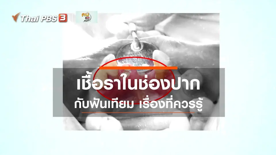 รู้สู้โรค : เชื้อราในช่องปากกับฟันเทียม