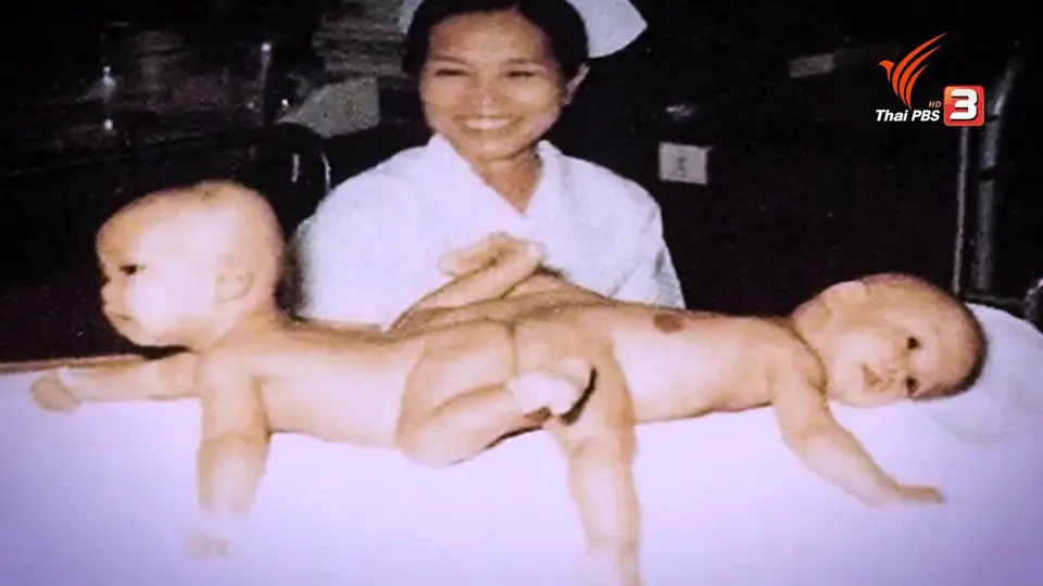 ​แฝดสยาม ปู-เป้ กับการผ่าตัดครั้งสำคัญ