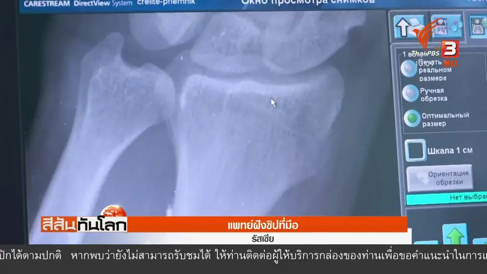 ​แพทย์ฝังชิปที่มือ