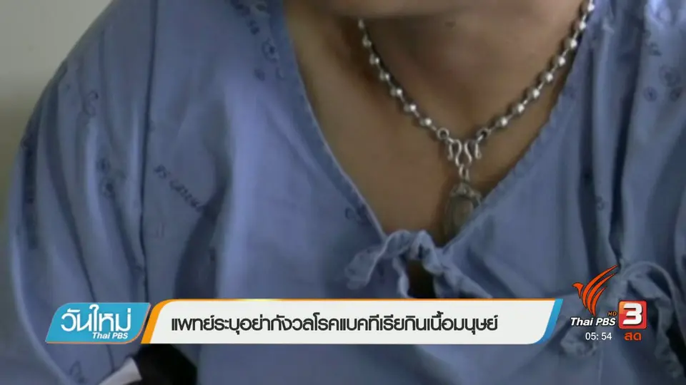 แพทย์ระบุอย่ากังวลโรคแบคทีเรียกินเนื้อมนุษย์