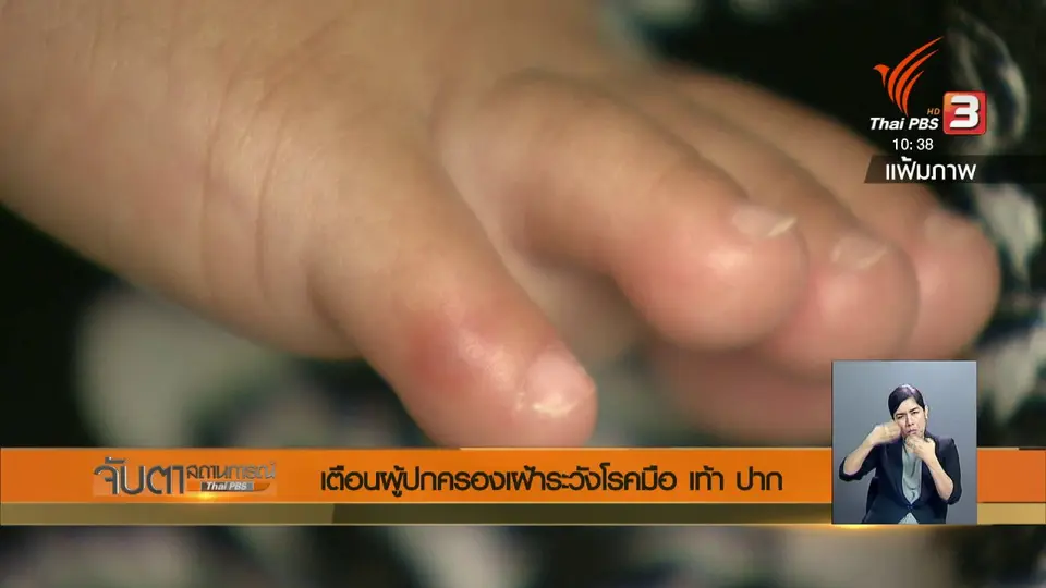 เตือนผู้ปกครองเฝ้าระวังโรคมือ เท้า ปาก