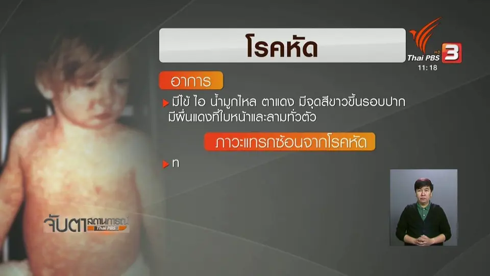 เตือนนำเด็กเล็กรับวัคซีนโรคหัดให้ครบ